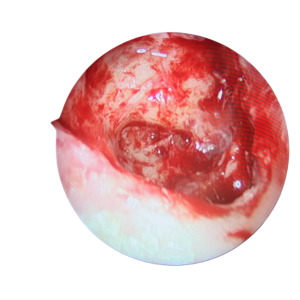 手術(shù)沒做干凈，術(shù)后3年顱內(nèi)竟發(fā)現(xiàn)巨大膽脂瘤！