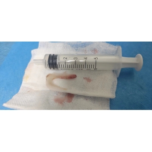 男子誤吞魚(yú)刺，術(shù)后取出3厘米長(zhǎng)倒置雙頭銳利魚(yú)骨，直呼僥幸得救！