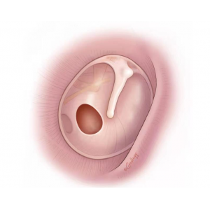 鼓膜穿孔不及時(shí)治療，會(huì)導(dǎo)致聽力下降，甚至引發(fā)顱內(nèi)感染？