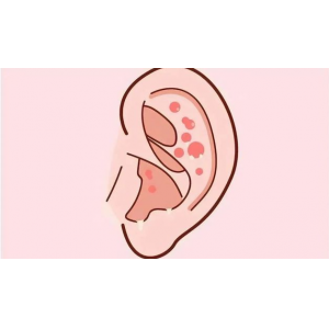 得了外耳道濕疹，怎么辦，快試試這三個(gè)方法