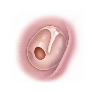 鼓膜穿孔能夠自愈嗎？鼓膜穿孔后應(yīng)該注意哪些？