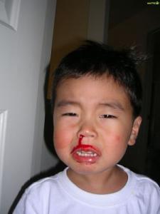 (貴陽(yáng)看鼻出血有那些方法)貴陽(yáng)哪個(gè)耳鼻喉科最好(圖2)