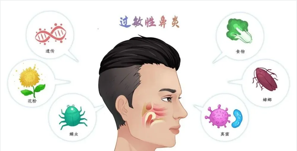 銘仁耳鼻喉專家分享：如何一招解決過敏性鼻炎的打噴嚏流鼻涕！(圖1)