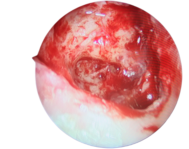 手術(shù)沒做干凈，術(shù)后3年顱內(nèi)竟發(fā)現(xiàn)巨大膽脂瘤！(圖1)