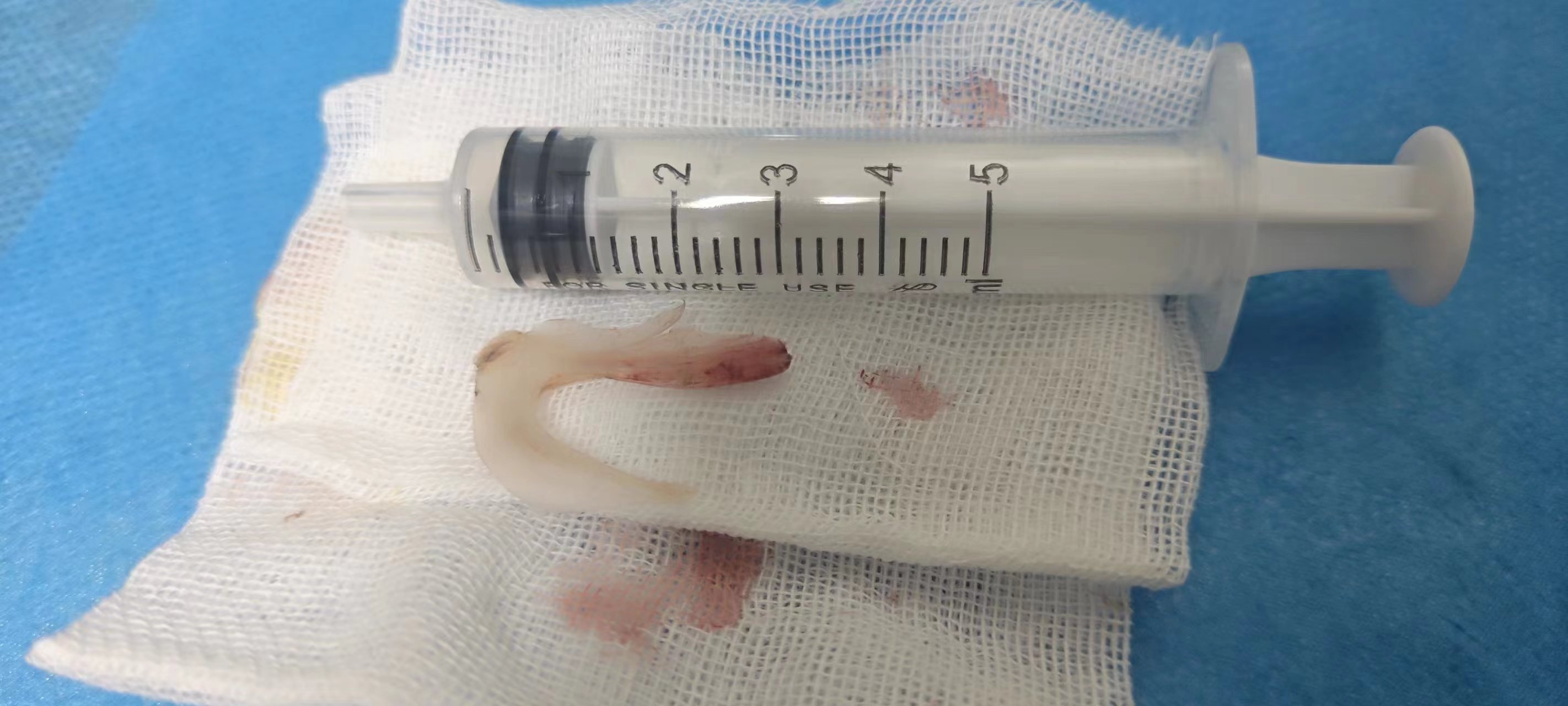 男子誤吞魚刺，術(shù)后取出3厘米長倒置雙頭銳利魚骨，直呼僥幸得救！(圖1)