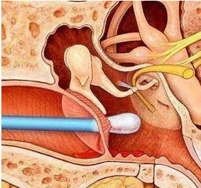 鼓膜穿孔不及時治療，會導致聽力下降，甚至引發(fā)顱內感染？(圖2)