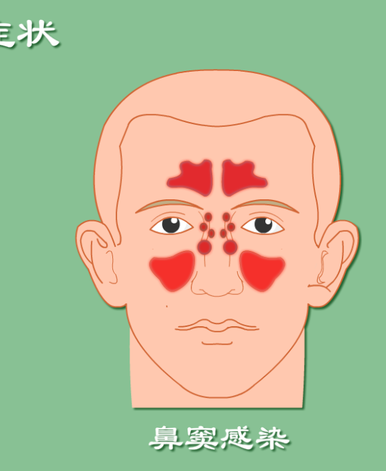 從腺樣體肥大到鼻竇炎，家長要小心這三步！(圖3)