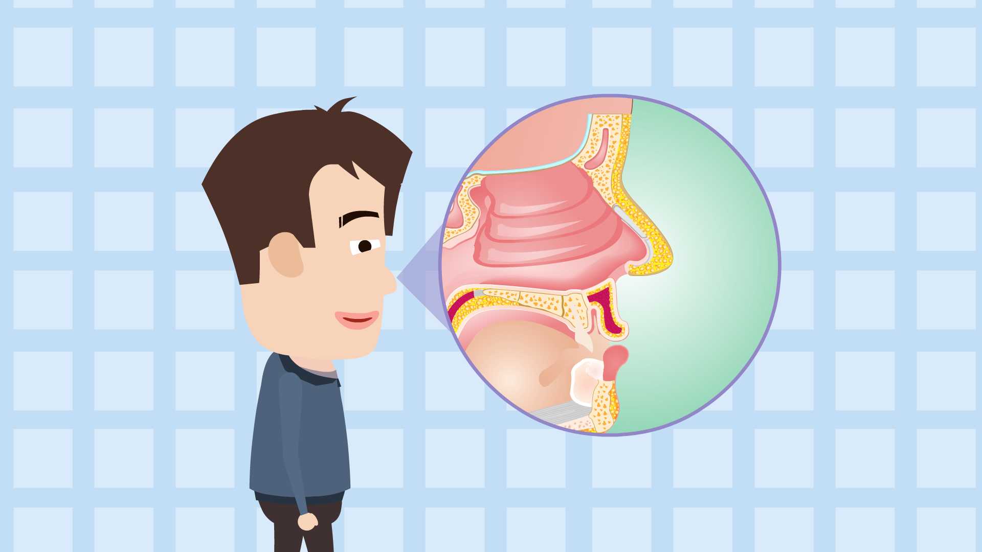 鼻塞、頭痛、嗅覺減退，注意可能是鼻息肉在作祟(圖1)