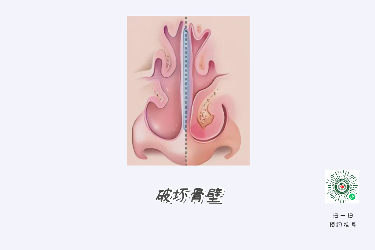 患上鼻竇炎不可小覷，當(dāng)心五大并發(fā)癥！(圖2)