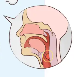 咽喉炎若不及時(shí)治療，可能會(huì)引發(fā)一系列并發(fā)癥(圖1)