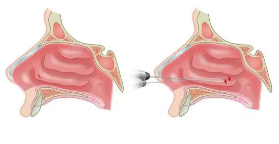 鼻甲肥大會(huì)引起面部結(jié)構(gòu)變化，還會(huì)導(dǎo)致眼袋、黑眼圈？(圖3)