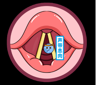 聲帶息肉，就像是聲帶長出了一個“小肉球”(圖2)