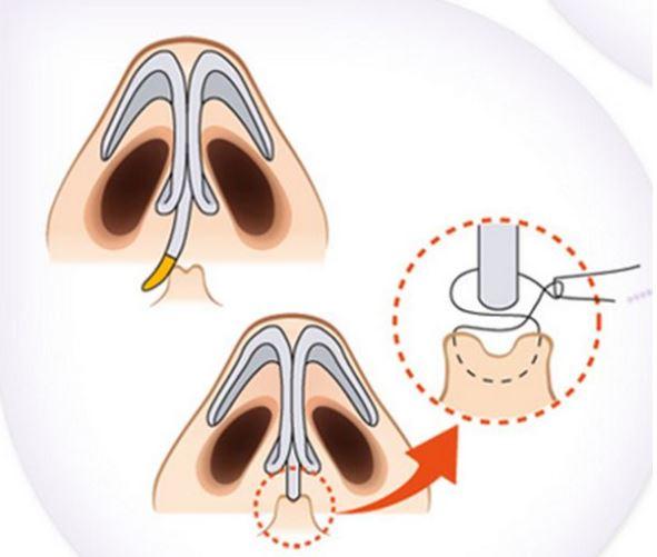 鼻中隔偏曲會(huì)導(dǎo)致睡眠障礙，甚至誘發(fā)心血管疾?。?圖1)
