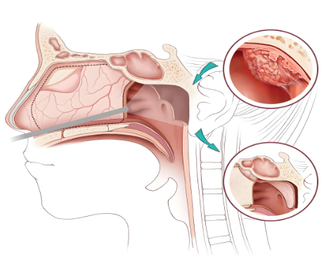 鼻塞，不只是感冒那么簡(jiǎn)單(圖2)