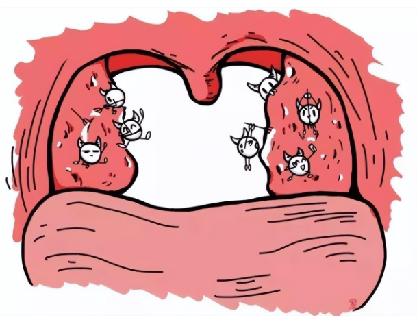 切除扁桃體會對身體產(chǎn)生危害嗎？(圖1)