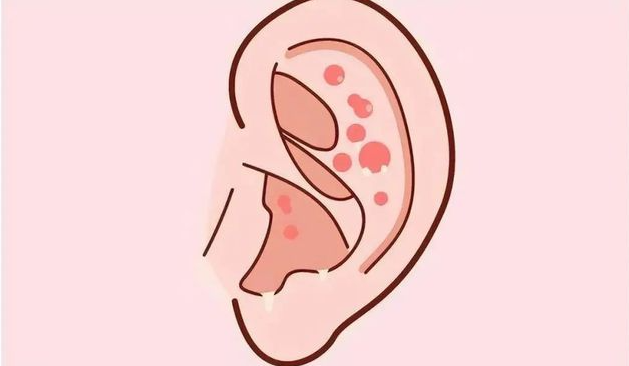 得了外耳道濕疹，怎么辦，快試試這三個(gè)方法(圖1)