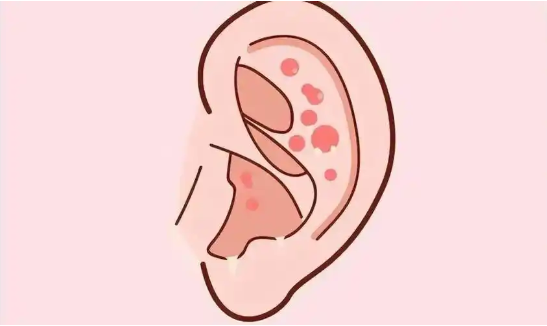 外耳道濕疹，小問題帶來大困擾(圖1)