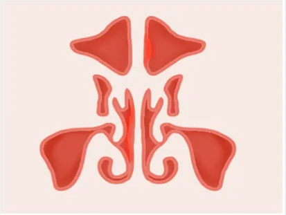 鼻塞、流膿性鼻涕、面部脹痛，慢性鼻竇炎該如何治療?(圖2)