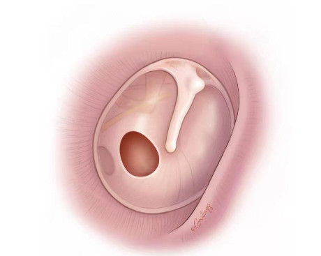 鼓膜穿孔能夠自愈嗎？鼓膜穿孔后應(yīng)該注意哪些？(圖1)
