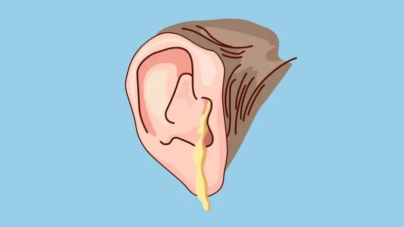 專家分享：中耳炎發(fā)作了怎么緩解疼痛？(圖1)