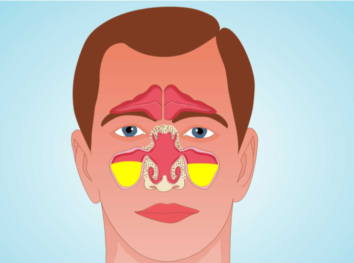 兒童鼻竇炎危害大，不要再當(dāng)普通感冒治療了(圖2)