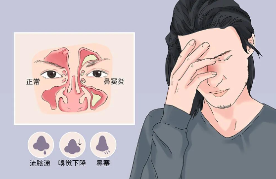 為什么感冒容易導致鼻竇炎，鼻竇炎該如何預防？(圖1)