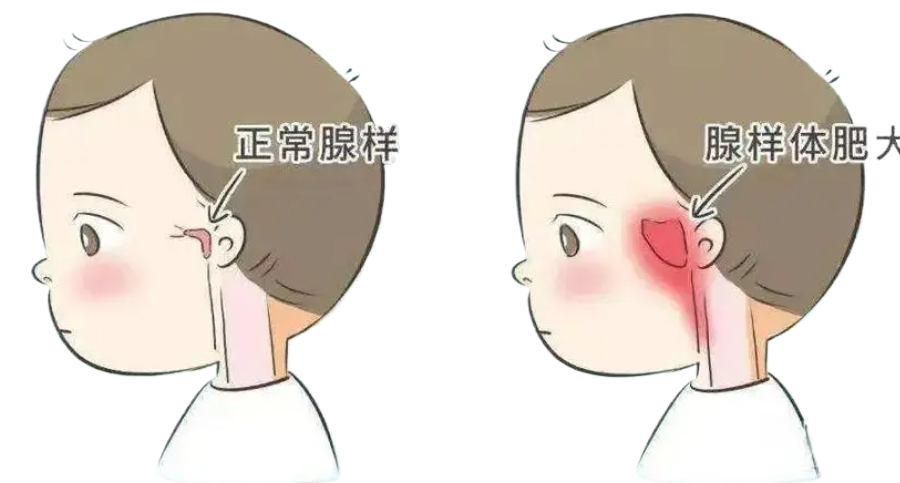 睡覺打呼嚕，記憶力下降？孩子腺樣體肥大怎么辦？(圖2)