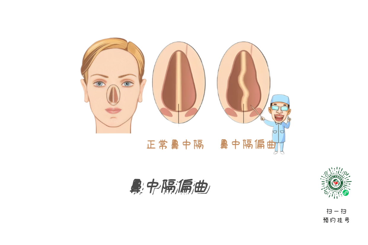 鼻塞、流涕、打噴嚏，是鼻炎引起的？注意可能是鼻中隔偏曲！(圖1)