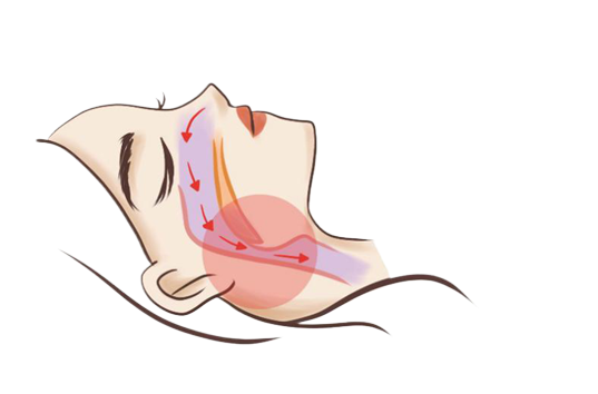 銘仁微創(chuàng)治療治好“呼嚕娃”，讓孩子不在打鼾！(圖1)