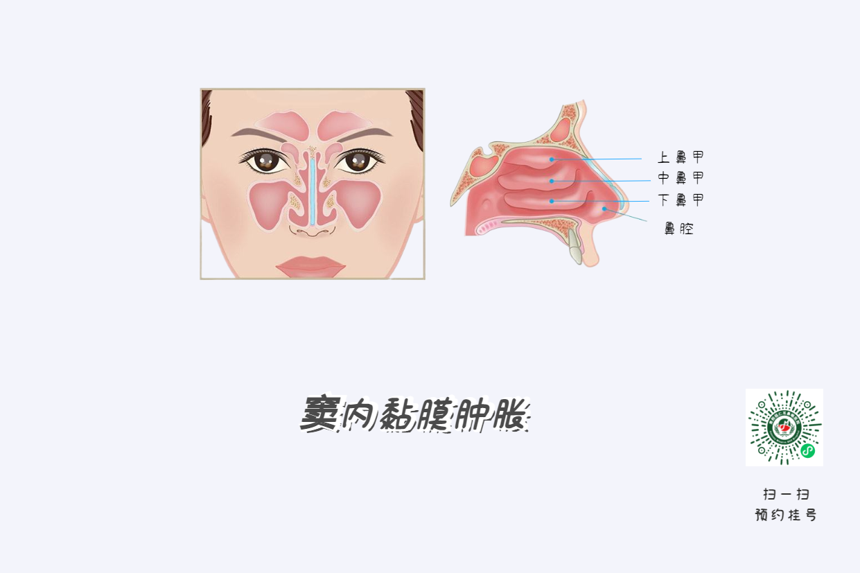 鼻竇炎頭痛有特點(diǎn)！這個(gè)位置痛要當(dāng)心(圖4)