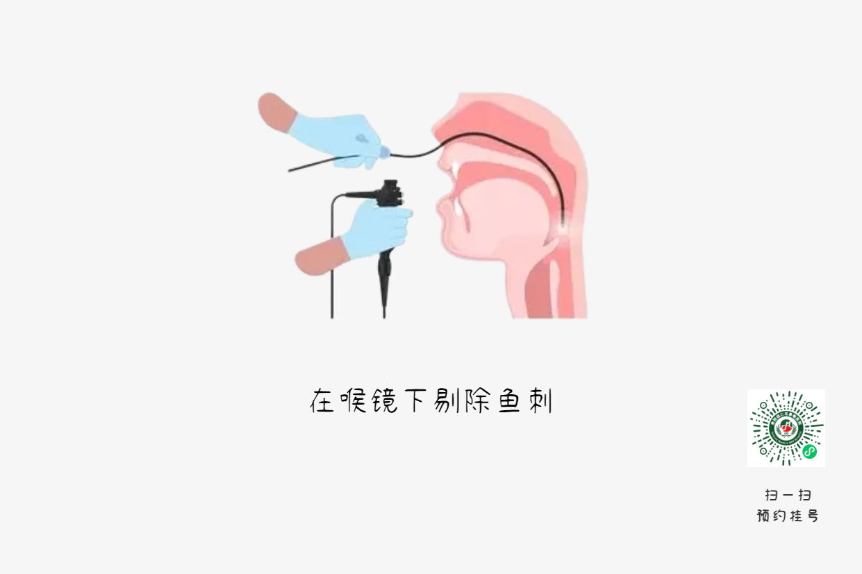 喉嚨卡魚刺？喝醋吞飯都是致命錯誤(圖2)