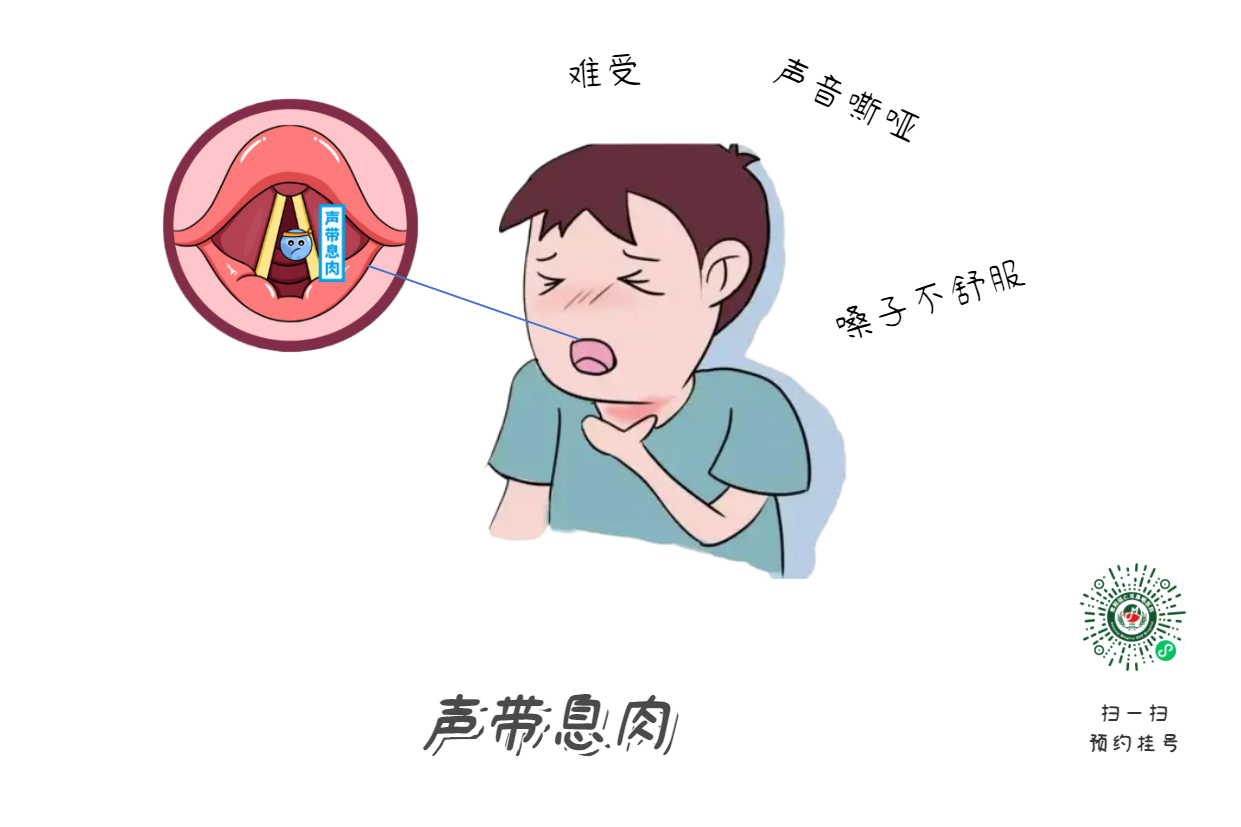 長期清嗓子？可能是聲帶息肉早期信號(圖1)