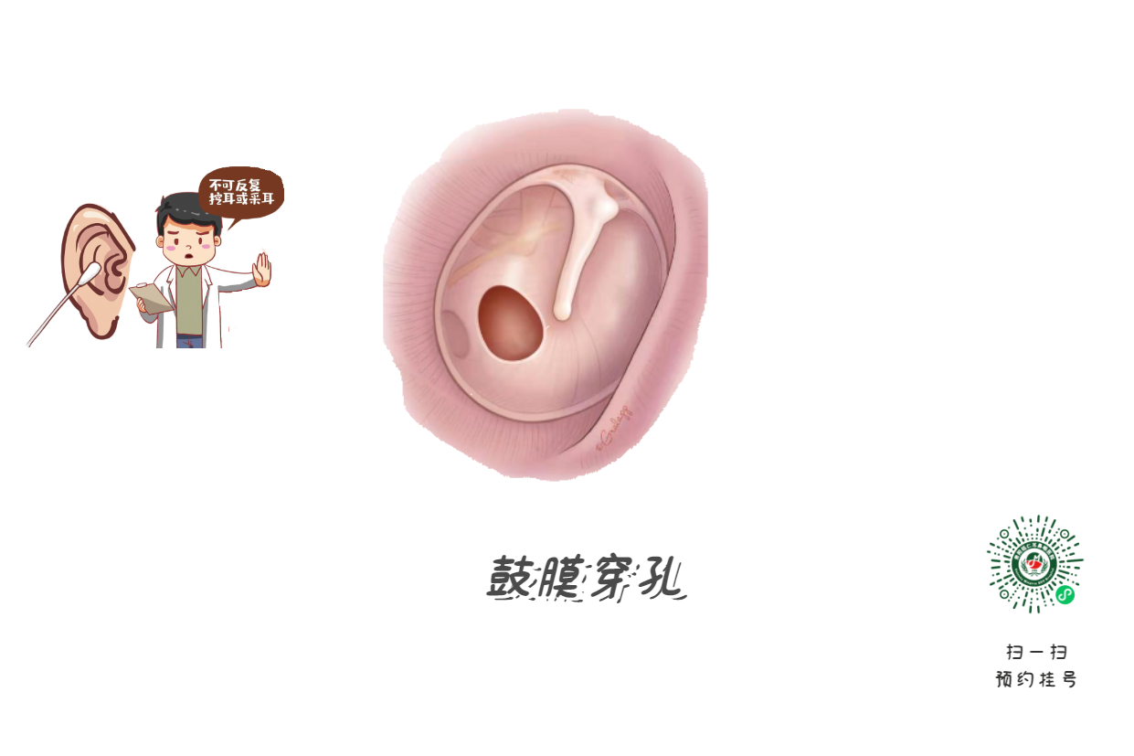 掏耳朵致鼓膜穿孔？這些動作最危險！(圖2)