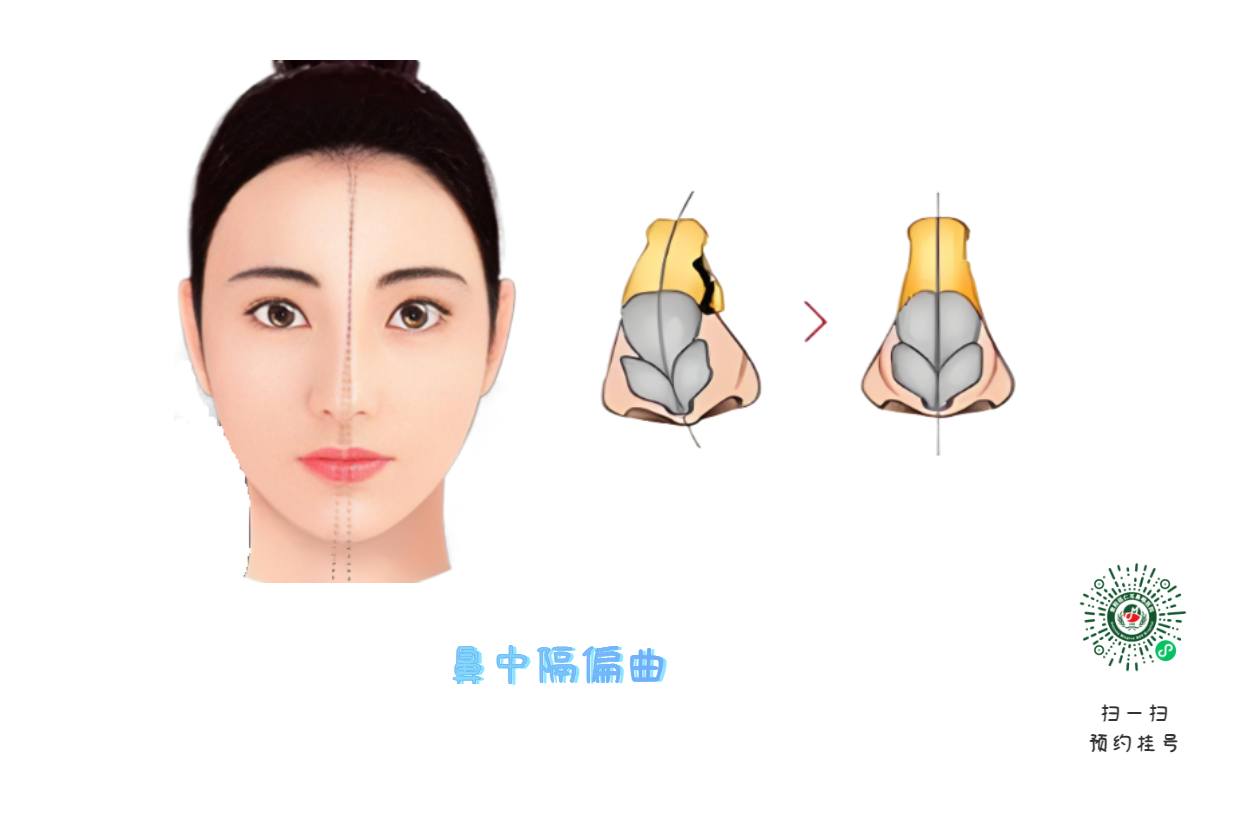 十年鼻塞不見(jiàn)好？問(wèn)題可能出在“鼻梁歪了”！(圖1)