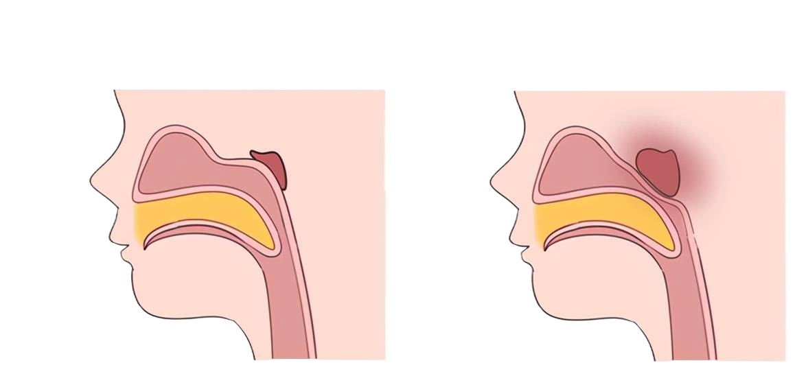 腺樣體影響智力？研究結(jié)果嚇壞家長(圖3)